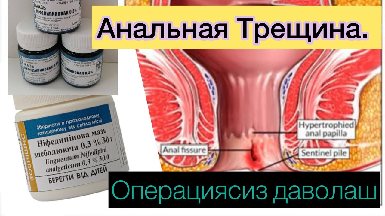 Анальная Трещина( анал ёриги) ни операциясиз хам даволаш мумкин. Фойдаланиб куриш керак. 909409209