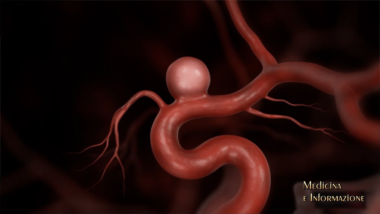 ANEURISMI CEREBRALI: si possono trattare in modo mininvasivo con la Neuroradiologia Interventistica