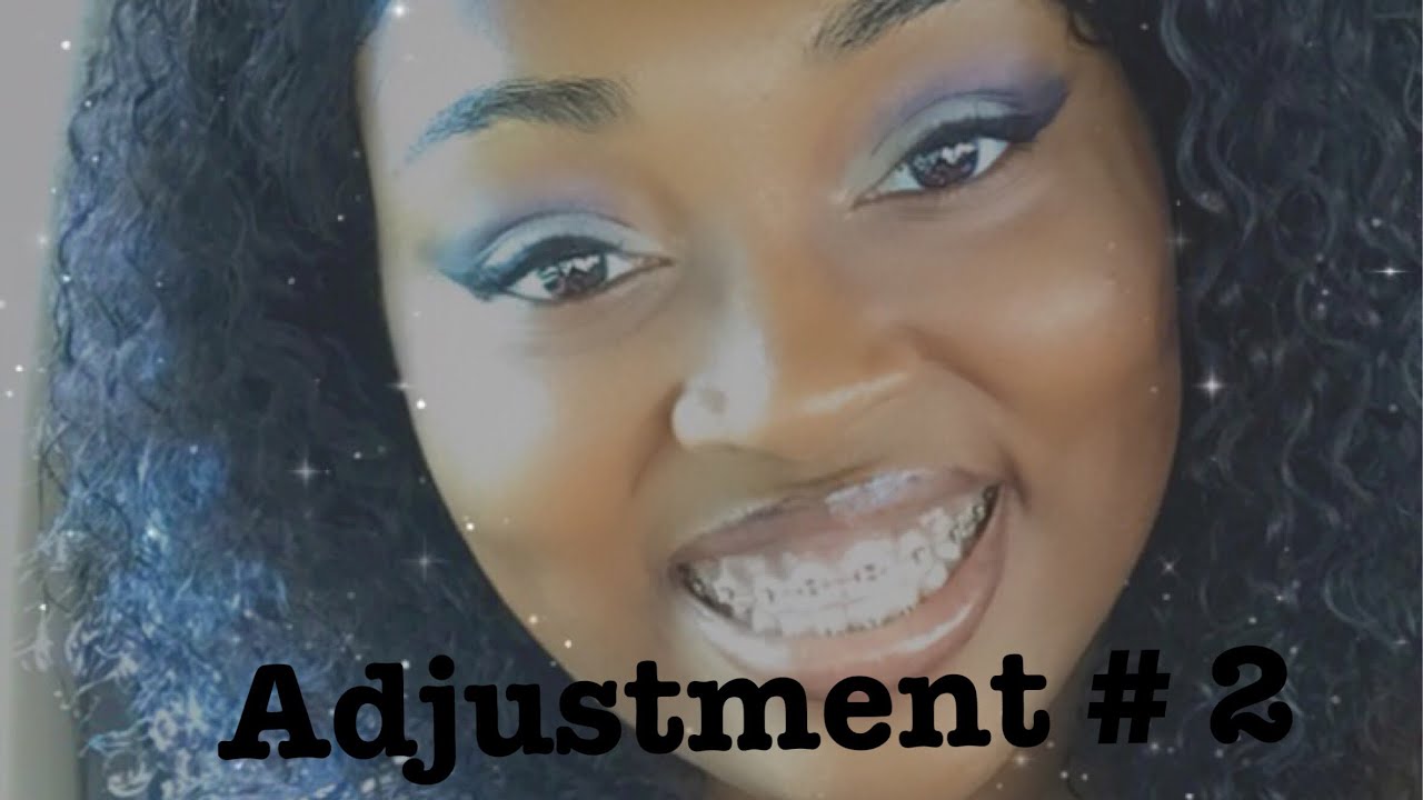 3 months with braces| 2nd adjustment