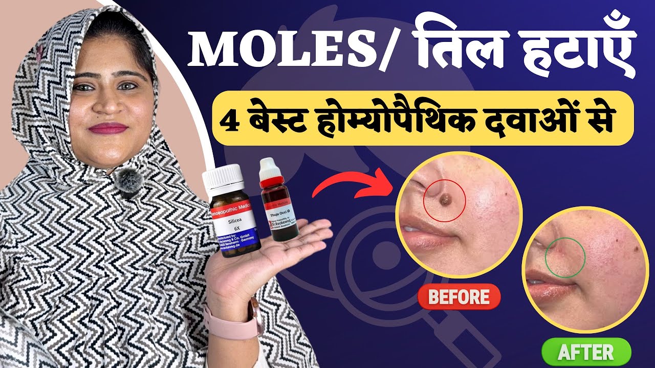 Moles (तिल) कैसे हटायें ? 4 Best Homeopathic Medicines for Moles | Dr. Arwa Bohra
