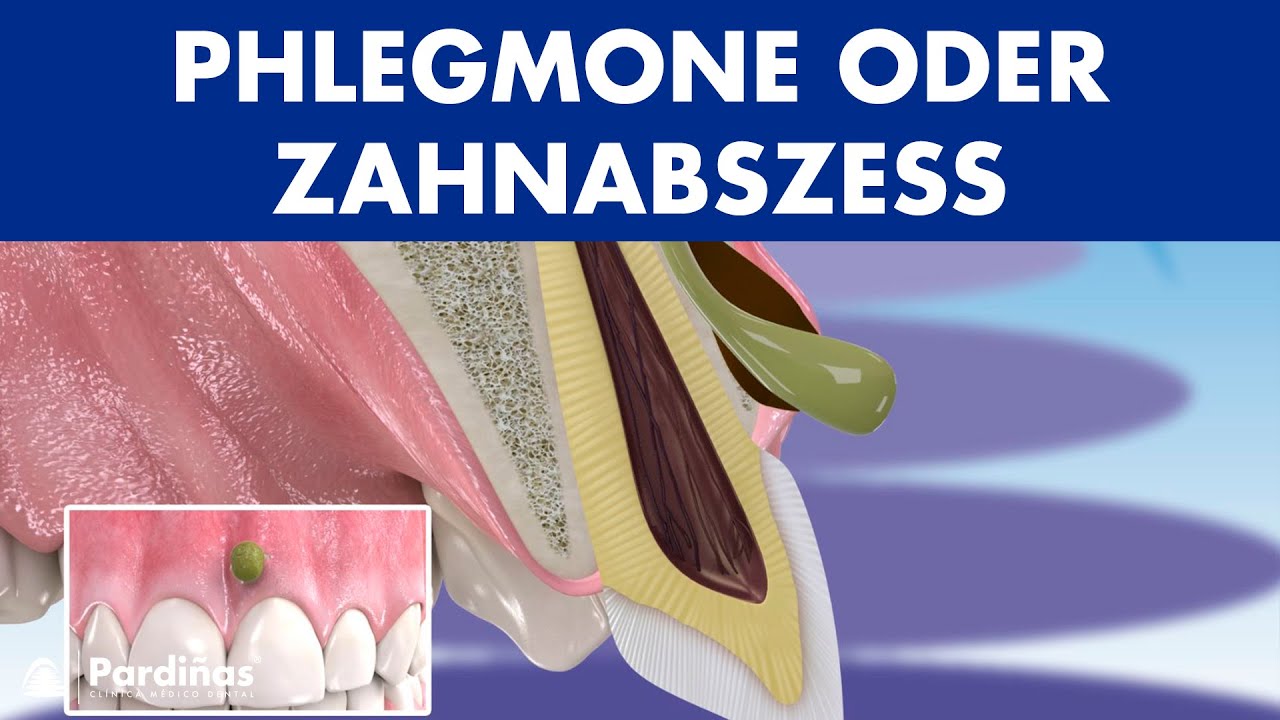 PHLEGMONE - Symptome und Behandlung von ABSZESS Zahnfleisch ©