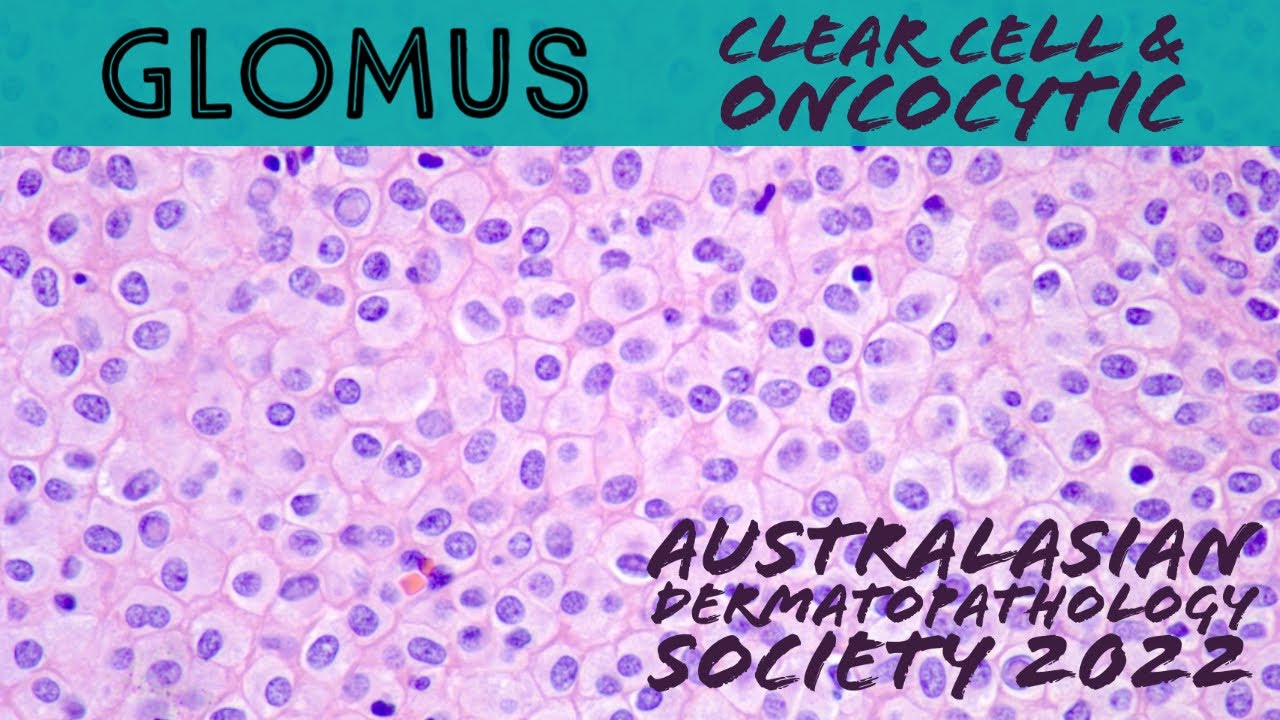 Glomus tumor with oncocytic & clear cell change mimic skin adnexal tumor (dermpath pathology)