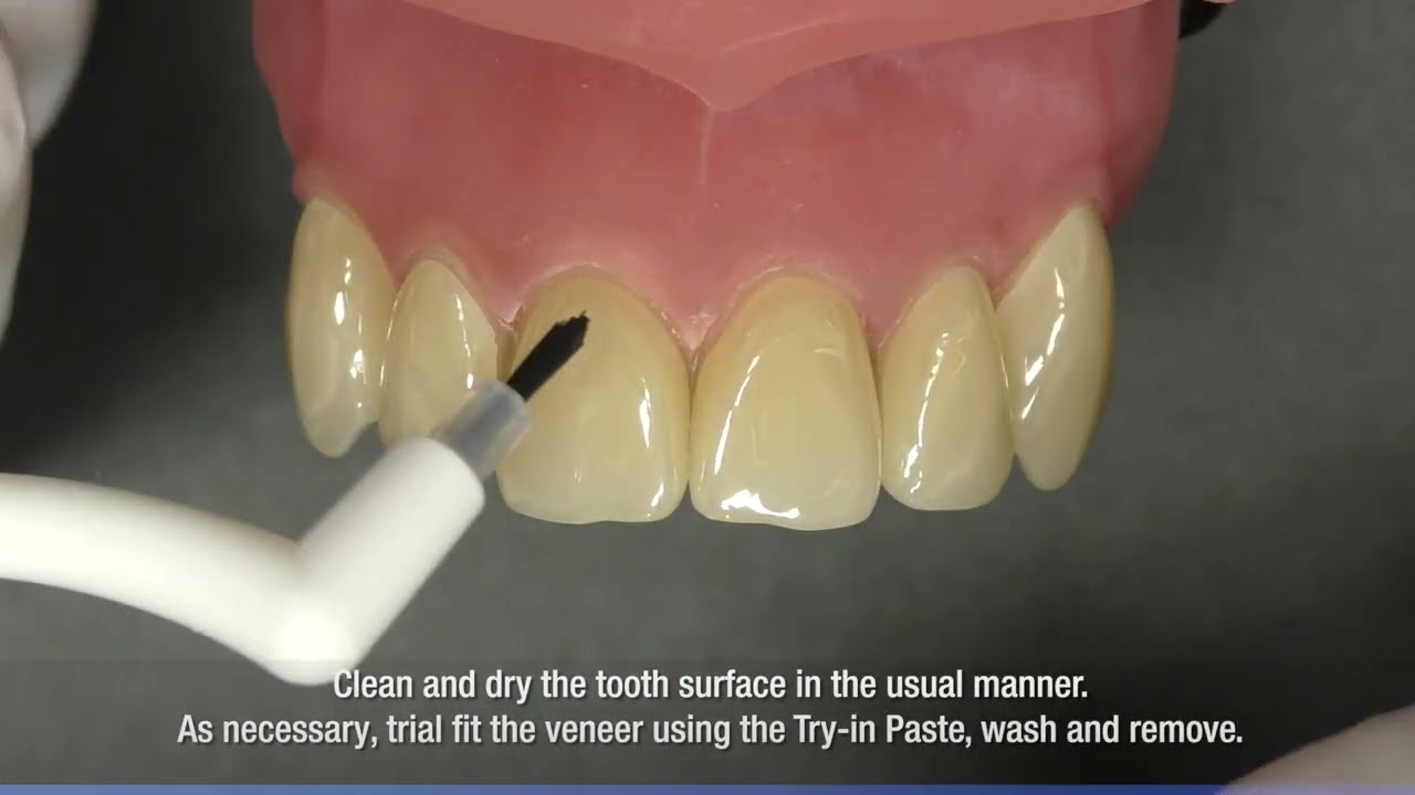 Panavia V5 how to work flow laminate veneer cementation