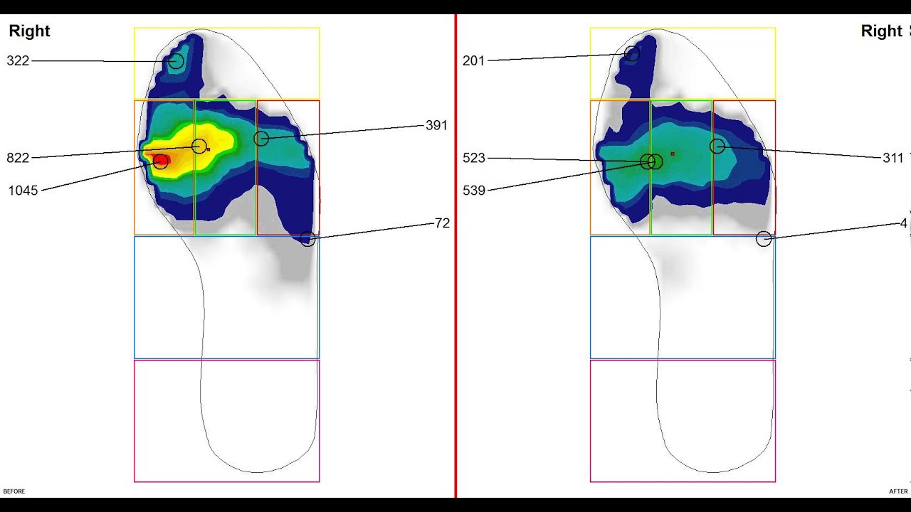 Analysing pedalling stability with foot pressure mapping