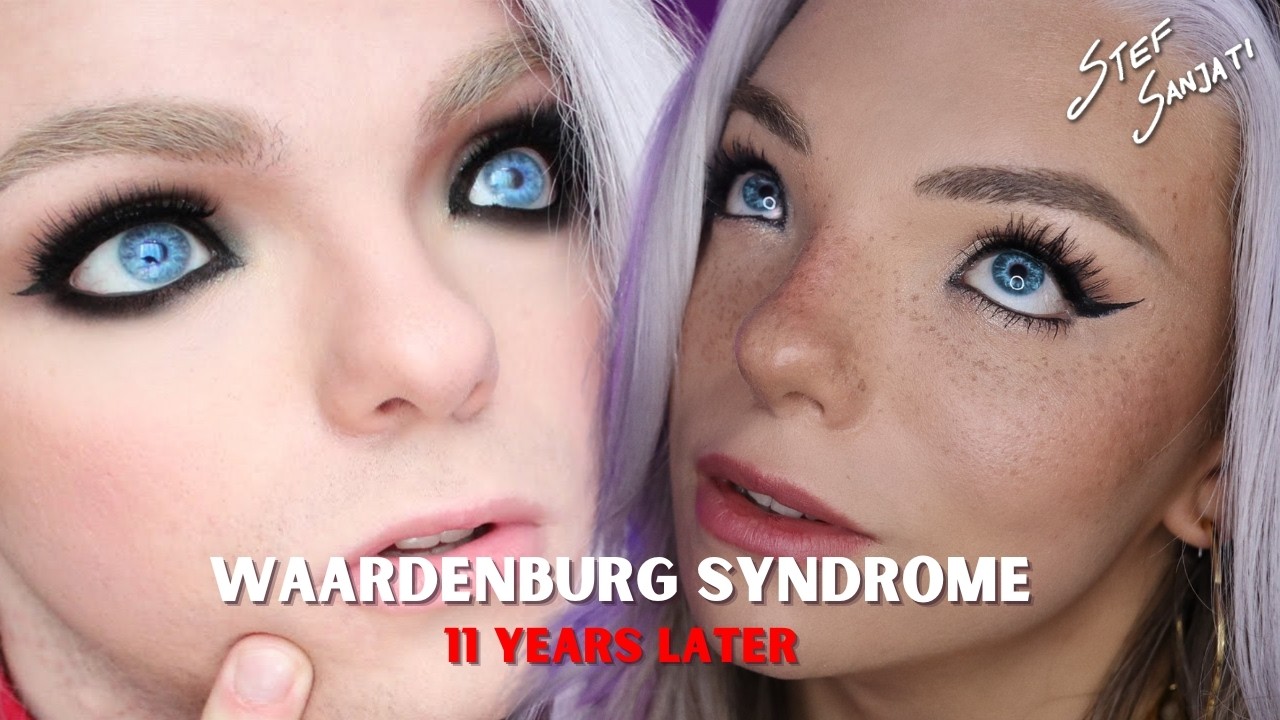 WAARDENBURG SYNDROME - 11 years later | Stef Sanjati