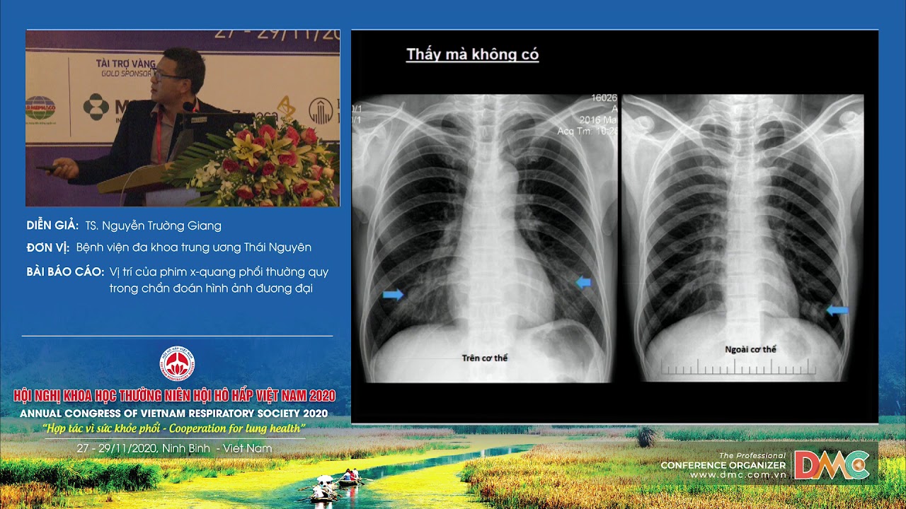 Vị trí của phim x-quang phổi thường quy trong chẩn đoán hình ảnh đương đại