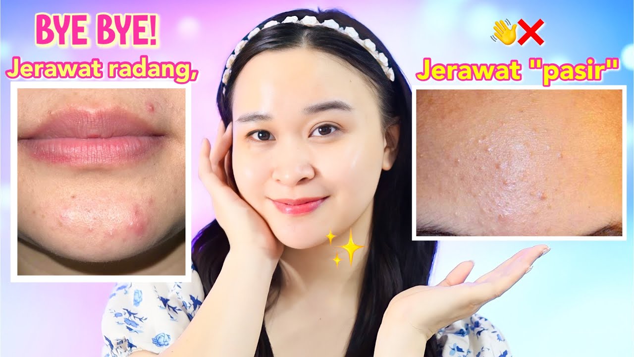 TOP 4 TIPS khusus bersihin JERAWAT PASIR & JERAWAT RADANG + REKOMENDASI (langsung praktek)✨