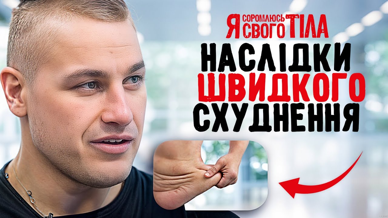 Страдает от лишней кожи – Я соромлюсь свого тіла | ЛЕЧЕНИЕ | ДОКАЗАТЕЛЬНАЯ МЕДИЦИНА | БОЛЕЗНИ