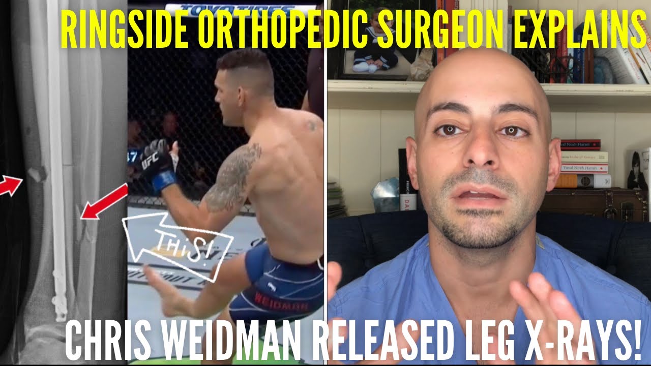 Ortho Surgeon of UFC Fighters EXPLAINS Chris Weidman&rsquo;s LEG X-RAYS‼️