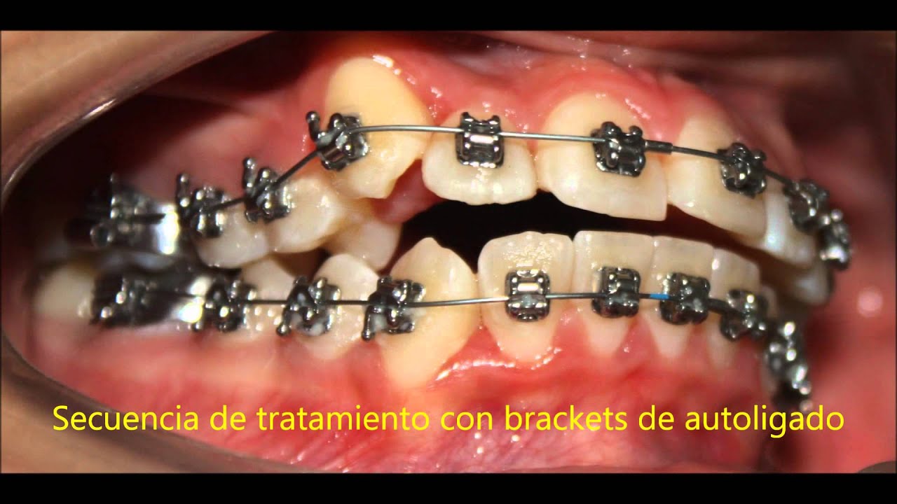 CASO CLINICO Brackets Autoligado y Elasticos