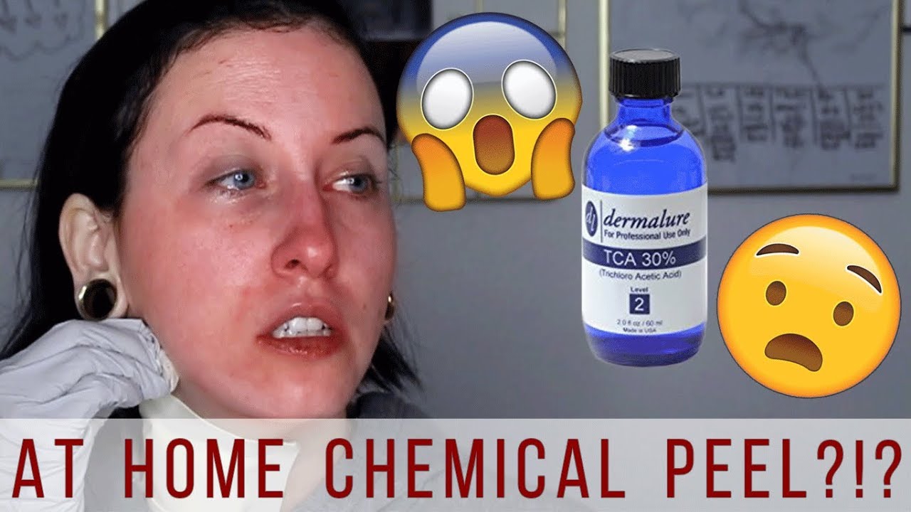 How to Do a TCA Peel at Home | TCA 30% Chemical Peel | Before & After Results
