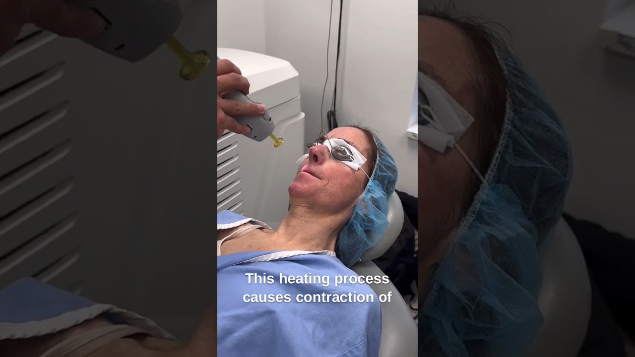 Laser Genesis - Wrinkle Reduction & Skin Tightening Treatment - Gentle Yag Pro Laser