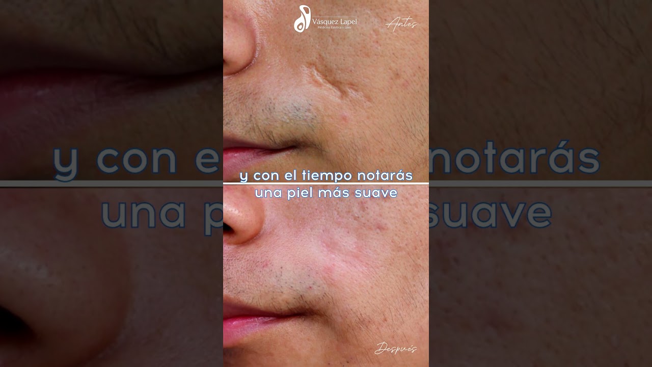 Tratamiento de cicatrices por accidentes con l&aacute;ser de CO2 fraccionado