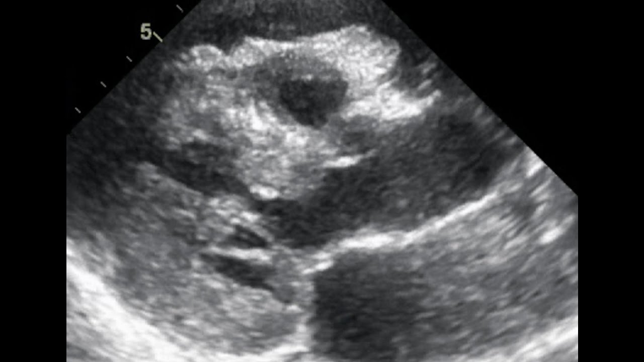 CARDIAC AMYLOIDOSIS ECHOCARDIOGRAPHY CASE1 - Dr. Alexandru Mischie