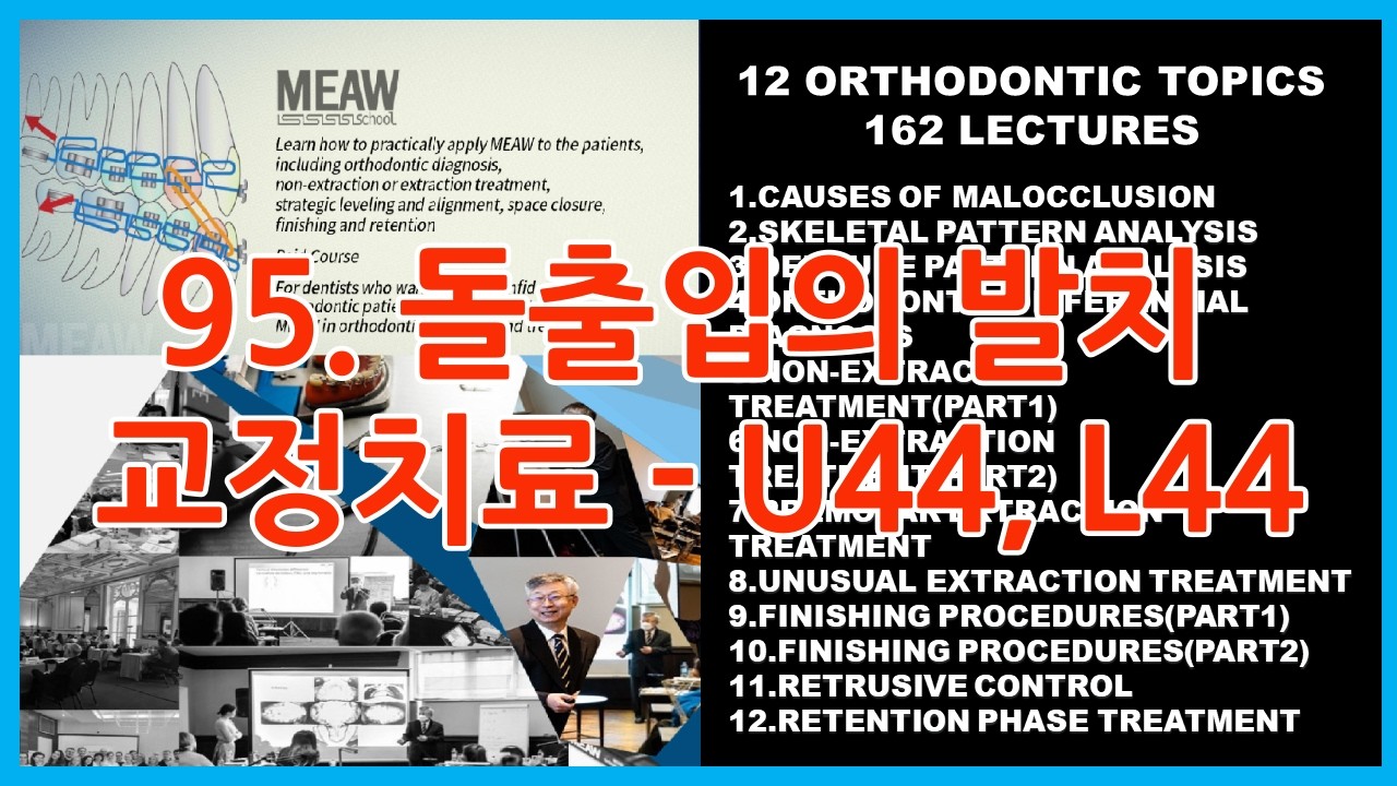 95.돌출입의 발치 교정치료 - U44, L44