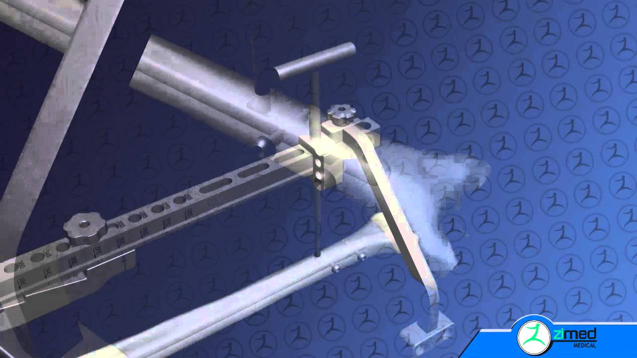 Zimed Tibial Nail (ZTN)