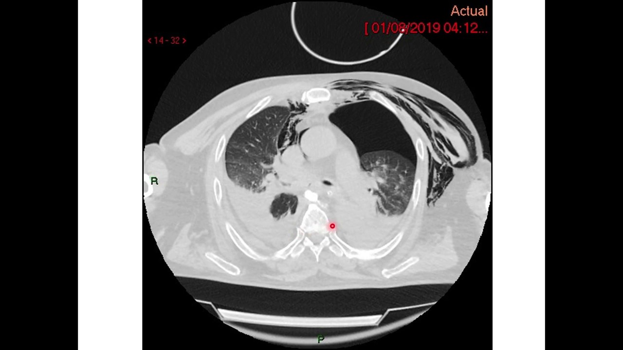 Hidroneumotorax y Neumomediastino