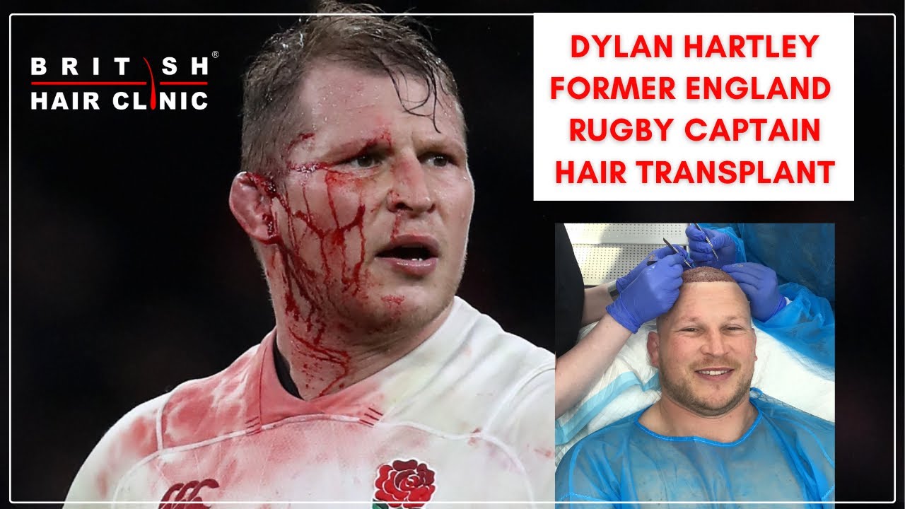 England Rugby captain Dylan Hartley Hair Transplant - British Hair Clinic.