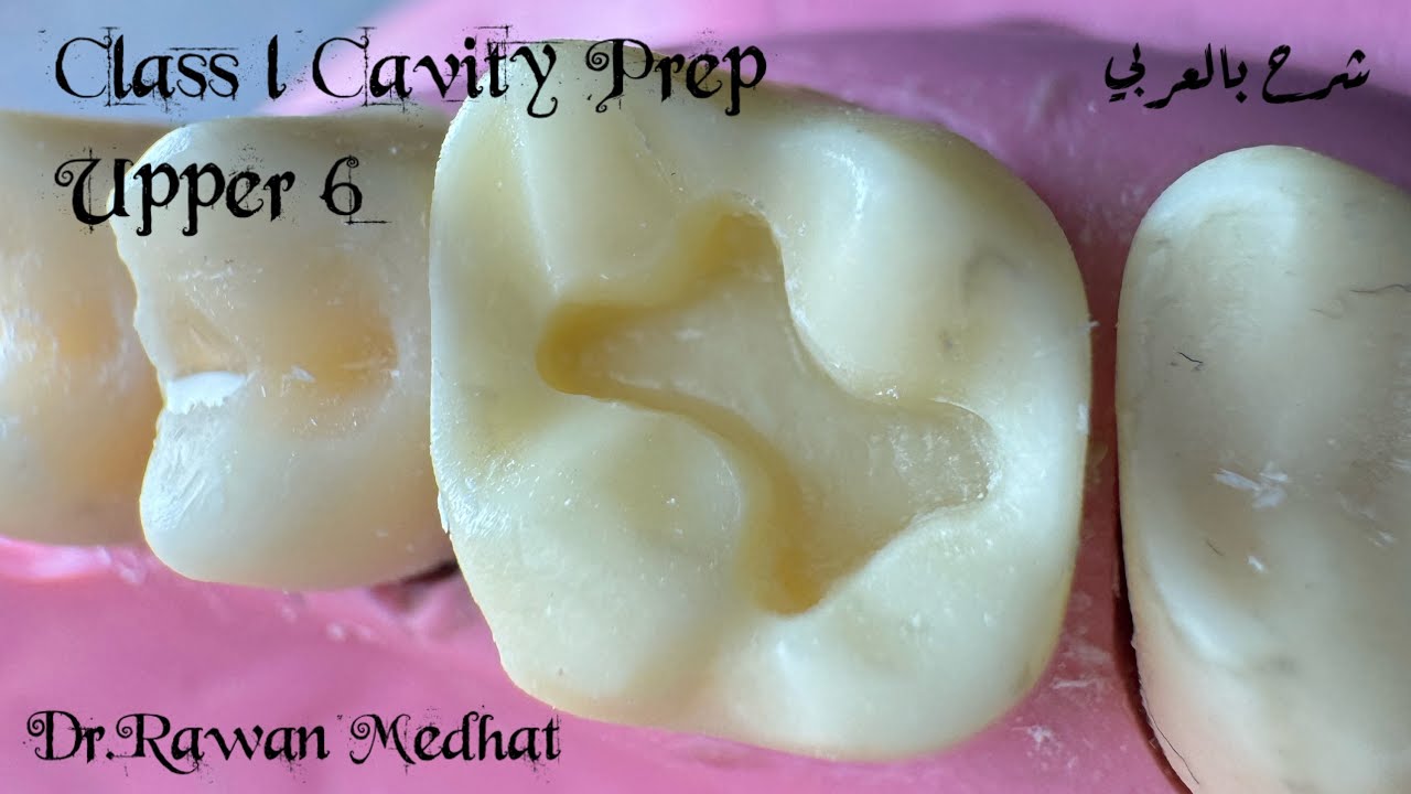 Class l Cavity Preparation | in Upper 6 | Dr Rawan Medhat | شرح بالعربي