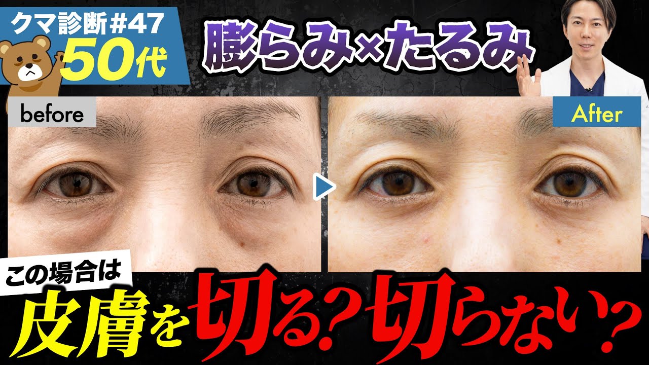【目の下のたるみ】たるみが強いクマでも「切らない」クマ取り治療が可能か徹底解説！［クマ診断＃047］#目の下のたるみを取る方法#目の下のたるみ#クマ取り #美容整形 #湘南美容クリニック