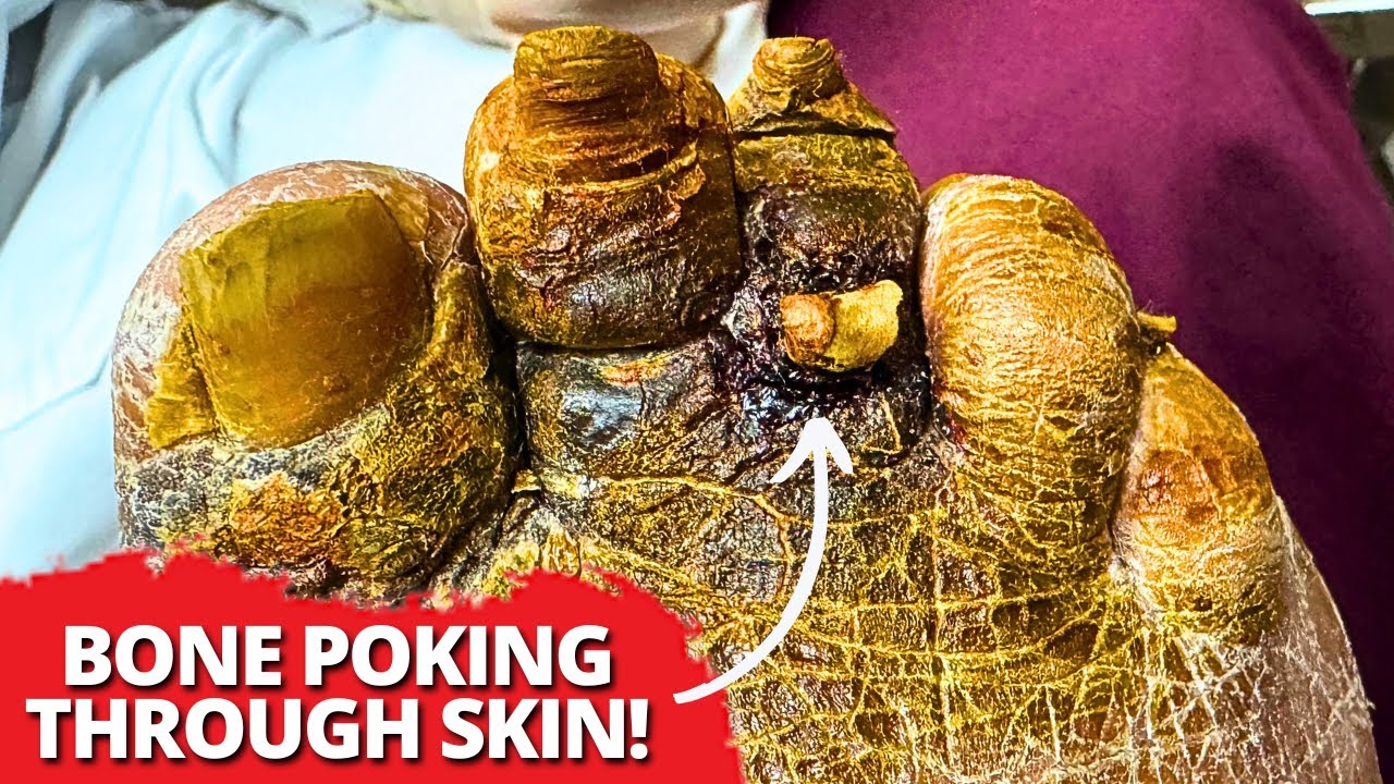 БЕЗУМНО торчит косточка на большом пальце ноги! 😱 Экстремальная стрижка ногтей и удаление омертве...