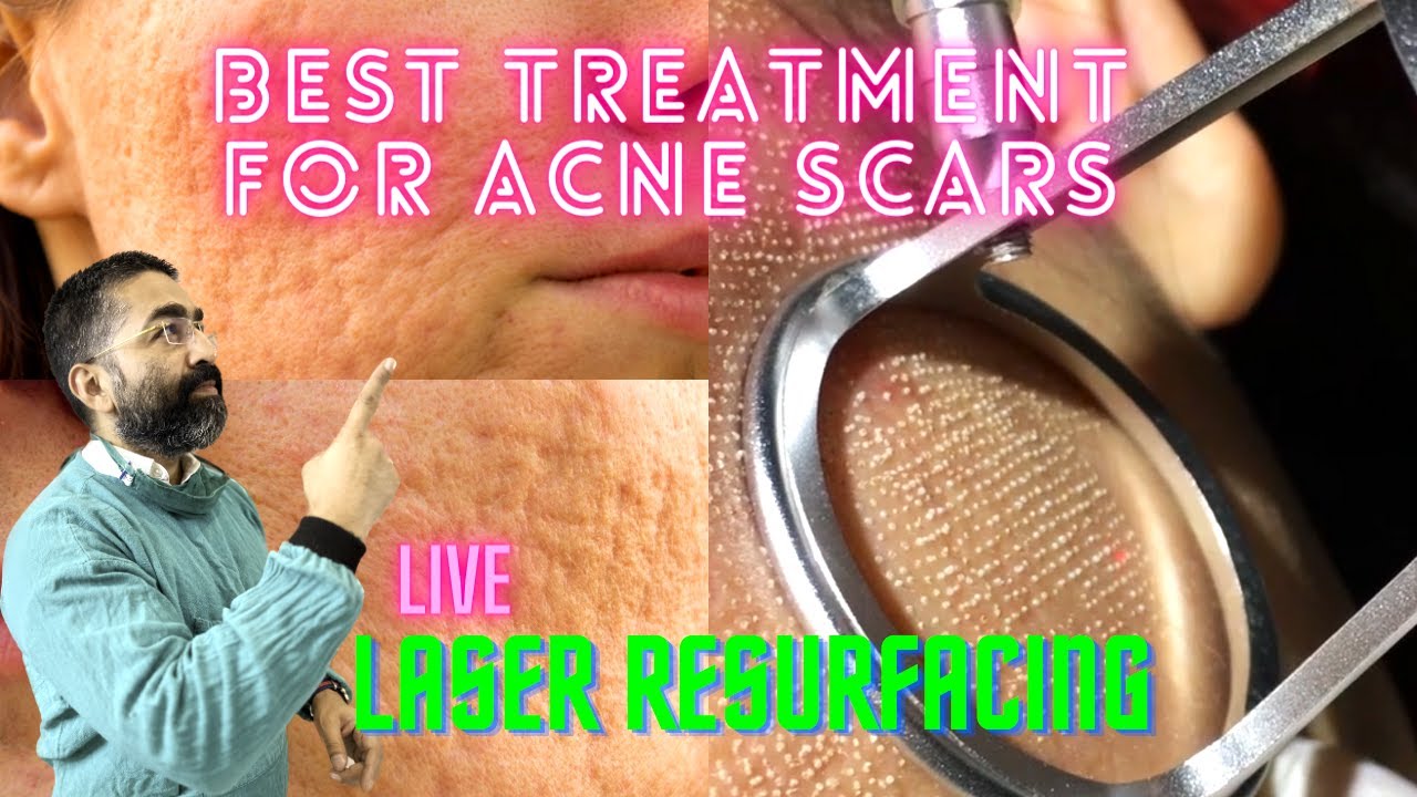 Best Laser Treatment for Acne Scars and Uneven Skin Tone REVEALED