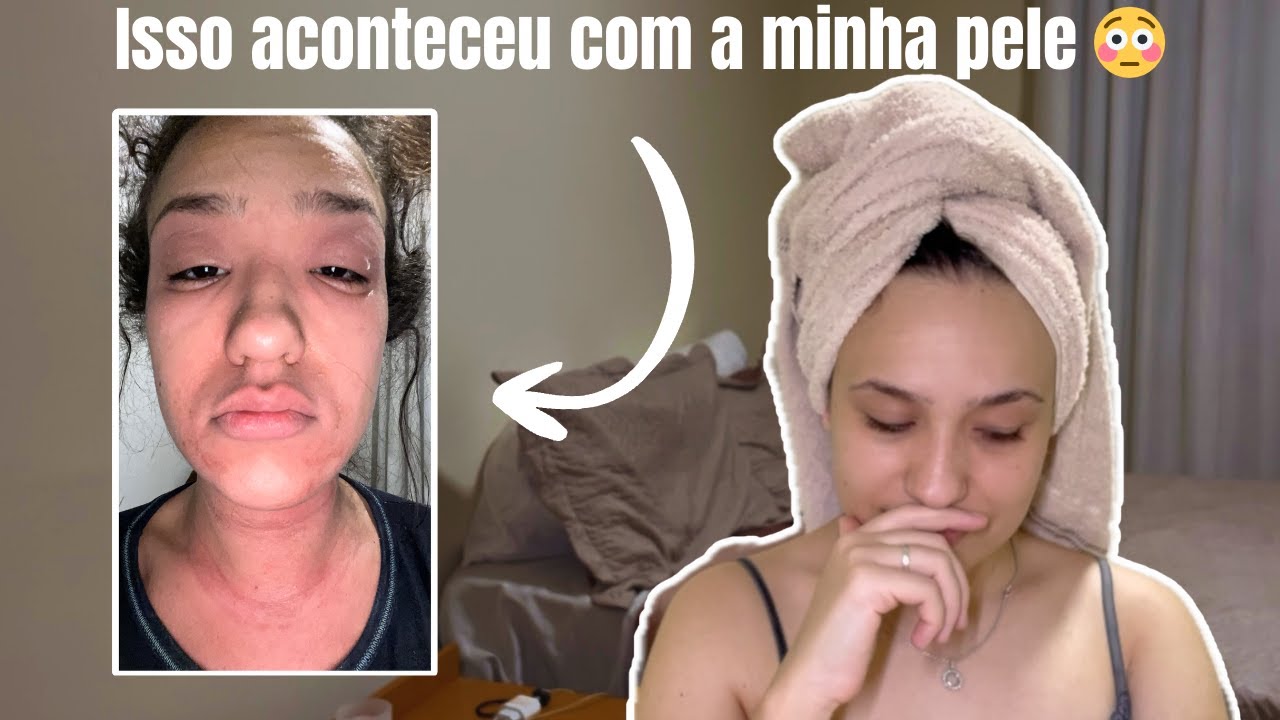 Minha rotina de autocuidado depois da pior alergia que já tive