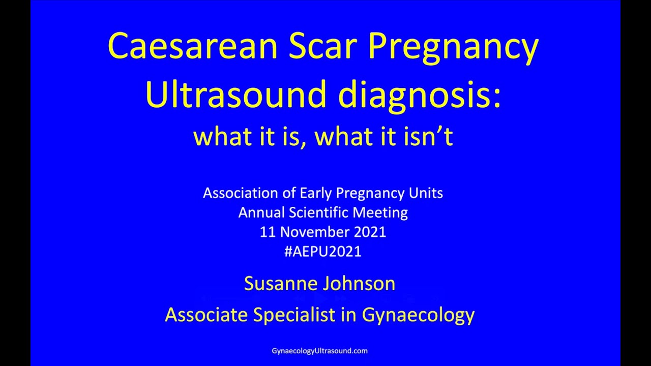 The Ultrasound Diagnosis of a Caesarean Scar Pregnancy for AEPU 2021 FI