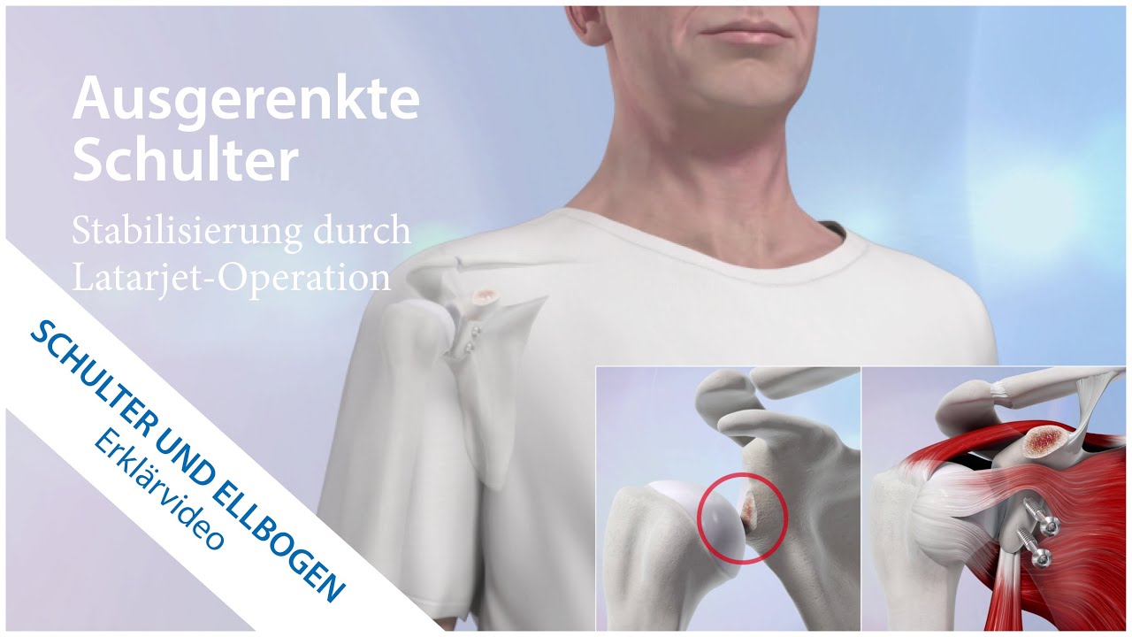 Chirurgische Behandlung der Schulterinstabilität