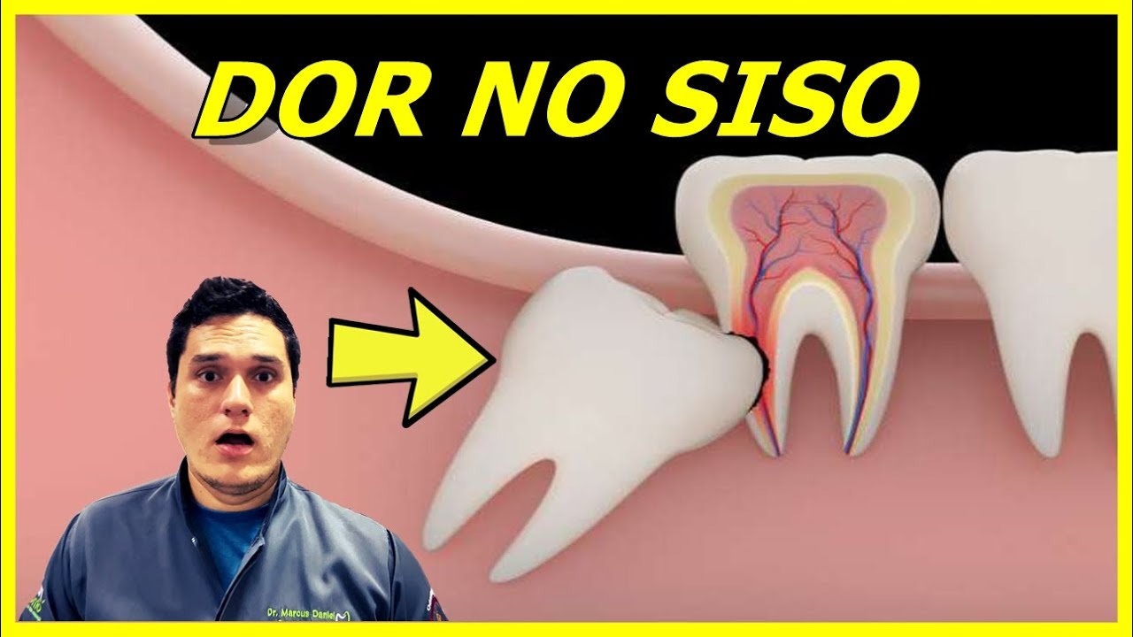 Dor no Dente Siso? Veja o que fazer!
