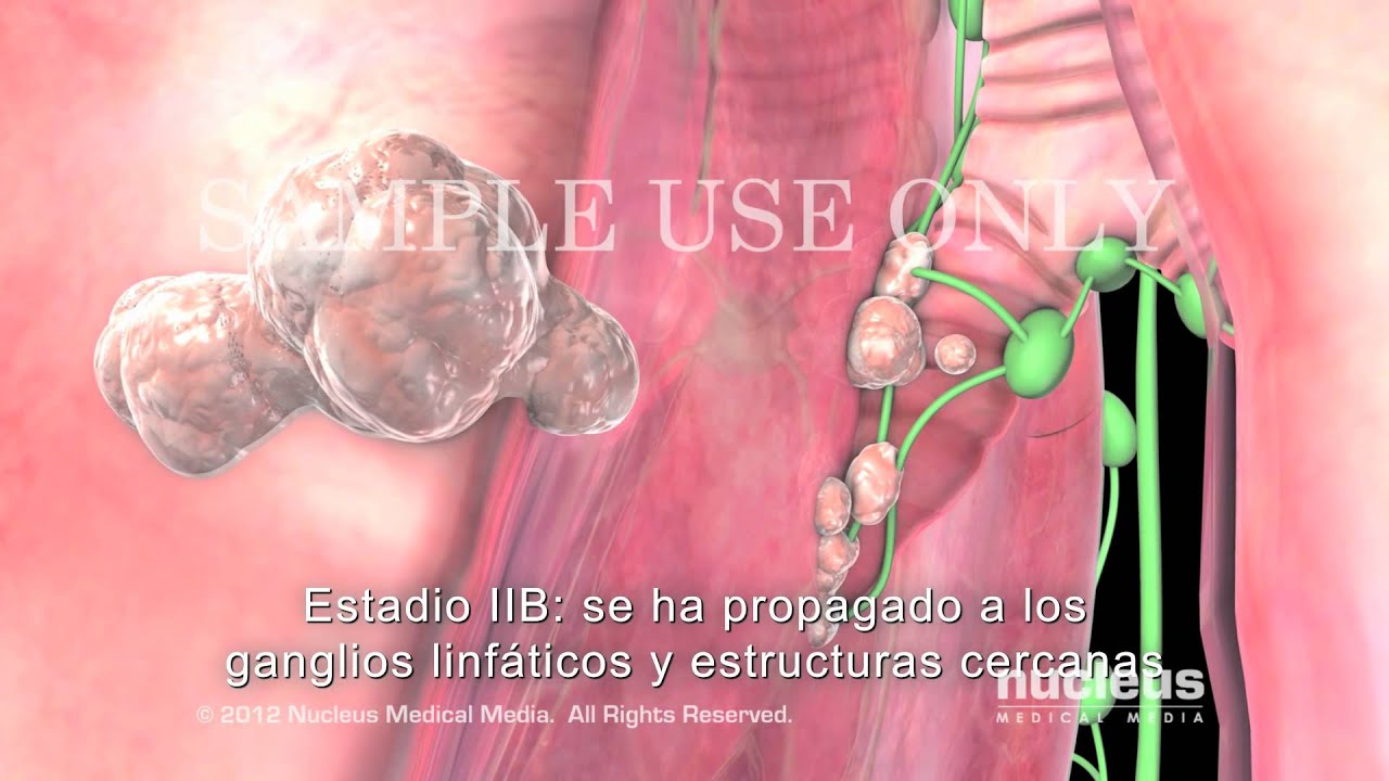 Progreso y estadificación del cáncer de pulmón