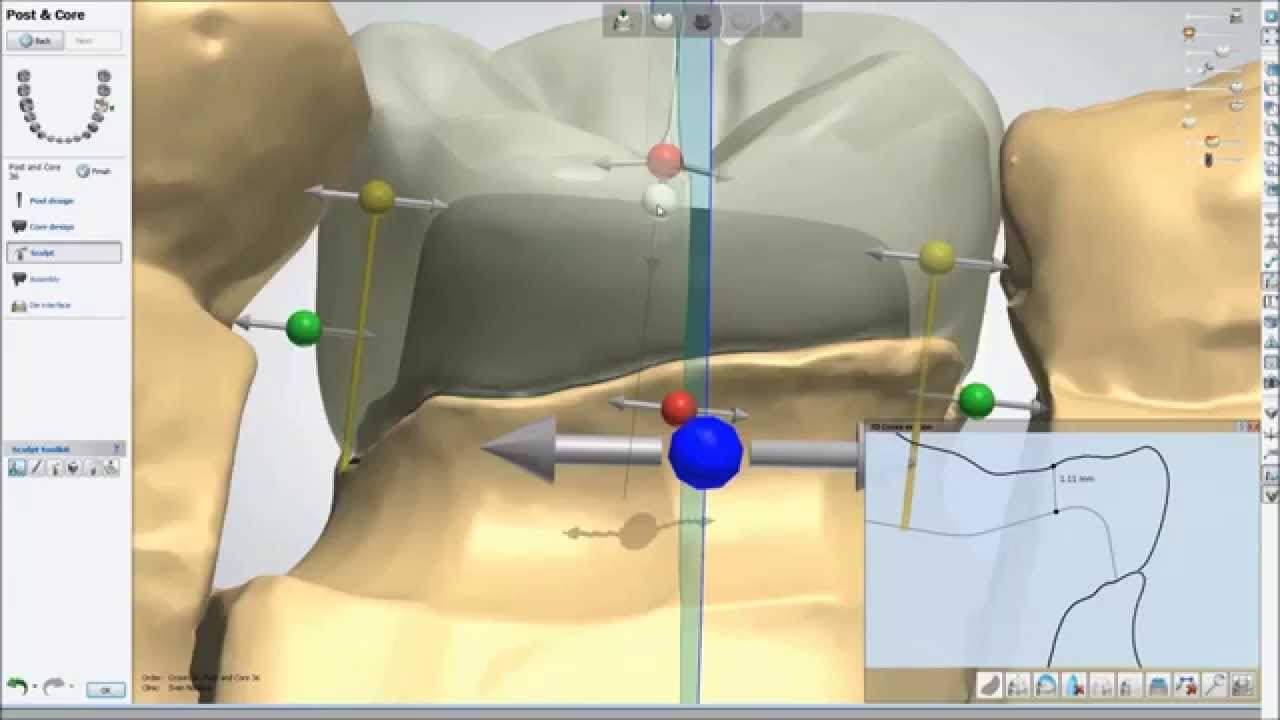 Dental System™ 2013 – Inlay-Core