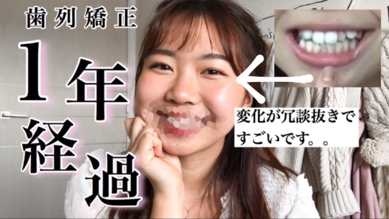 「なごの矯正日記#26」１年経過 アップデート！！(写真＆解説）