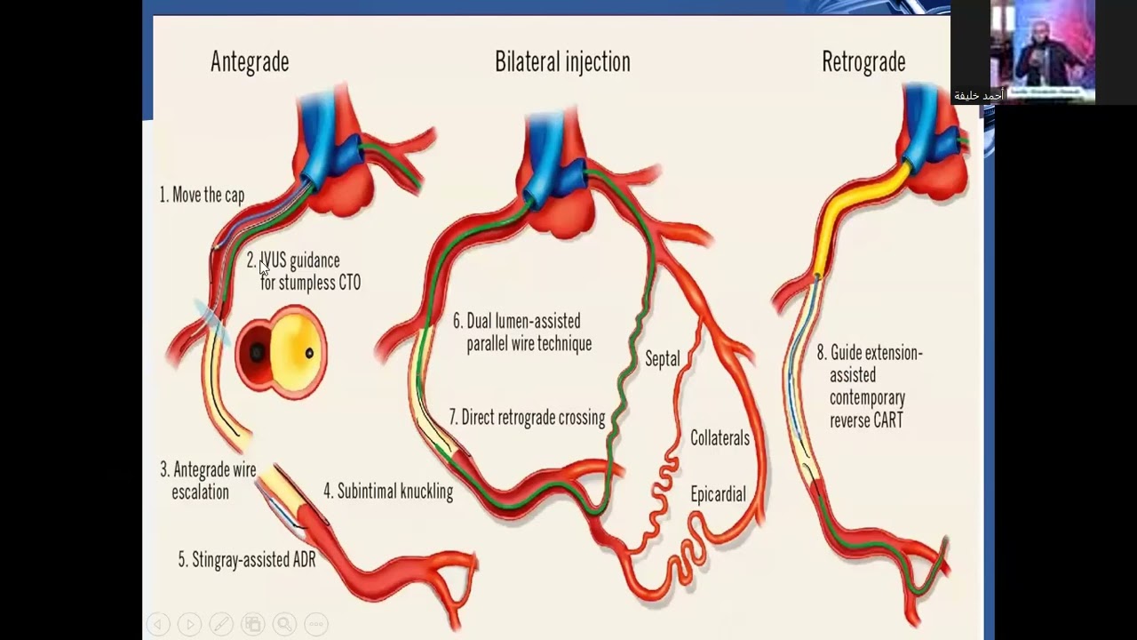 1 Retrograde Algorithm,angiography,steps