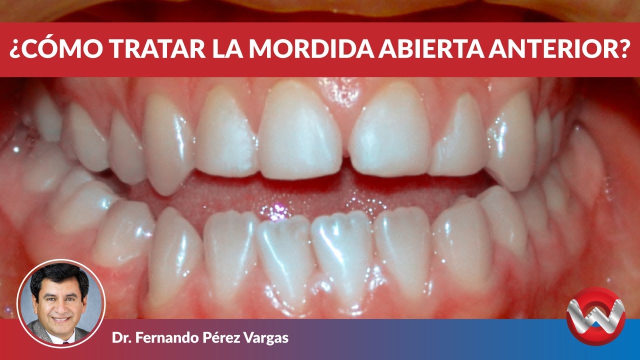 Mordida Abierta Anterior, Cuáles son sus Causas y Tratamiento