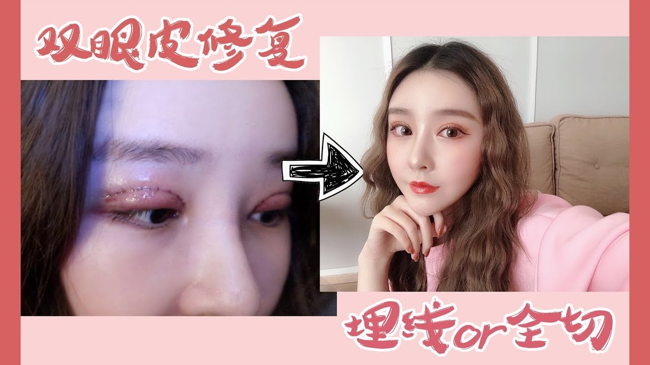 双眼皮vlog: 修复手术全记录👩🏻‍⚕️埋线全切哪个好??!