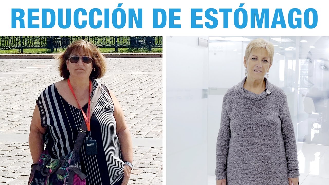 Manga Gástrica Testimonios | Opiniones Clínicas Diego de León
