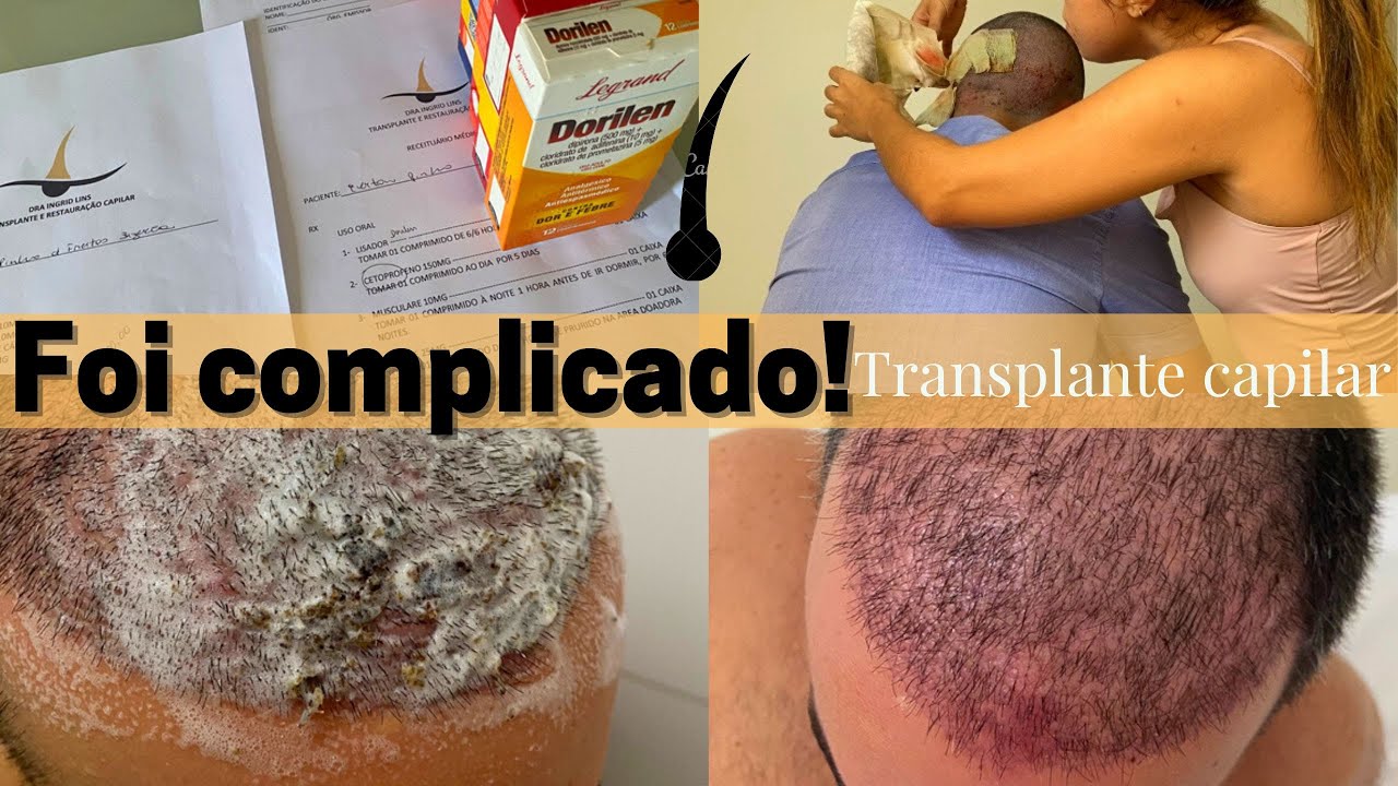 TRANSPLANTE CAPILAR| O PÓS foi mais difícil do que pensávamos! |primeira lavagem, cuidados, remédios