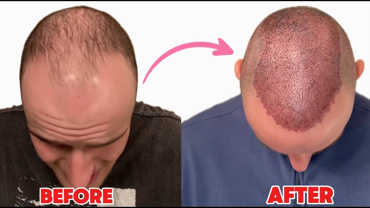 My Hair Transplant 3 month update | Before & After