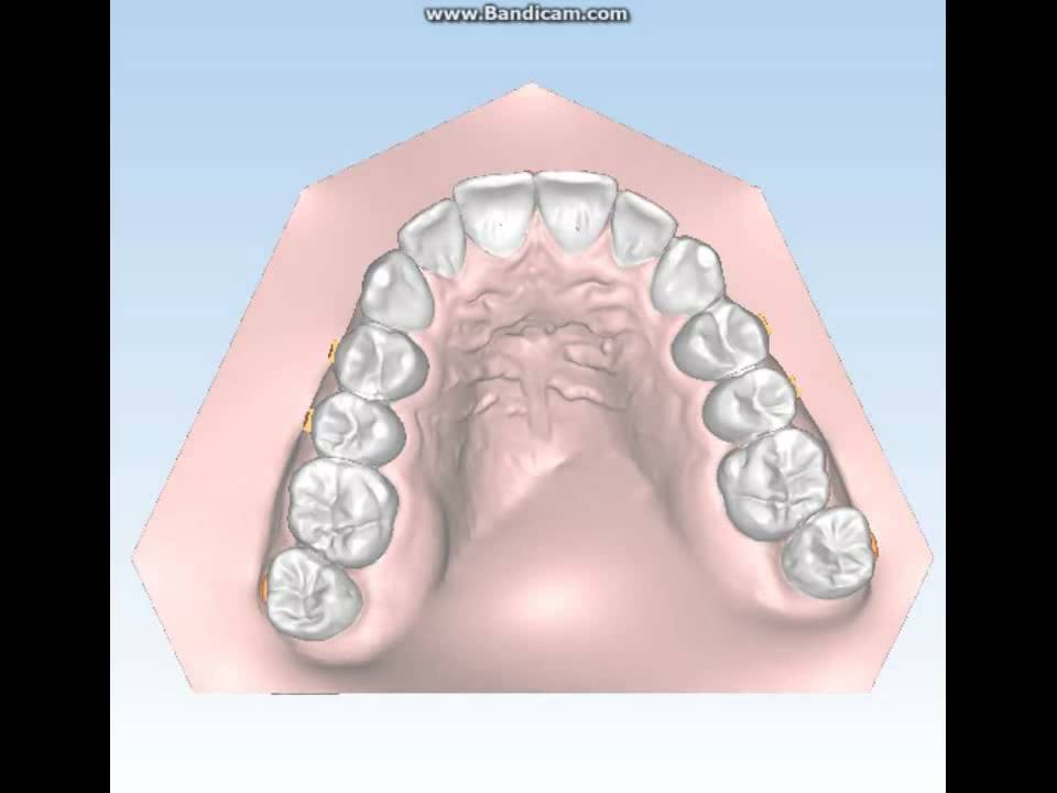 Ortodonzia Invisibile Aurodental 2