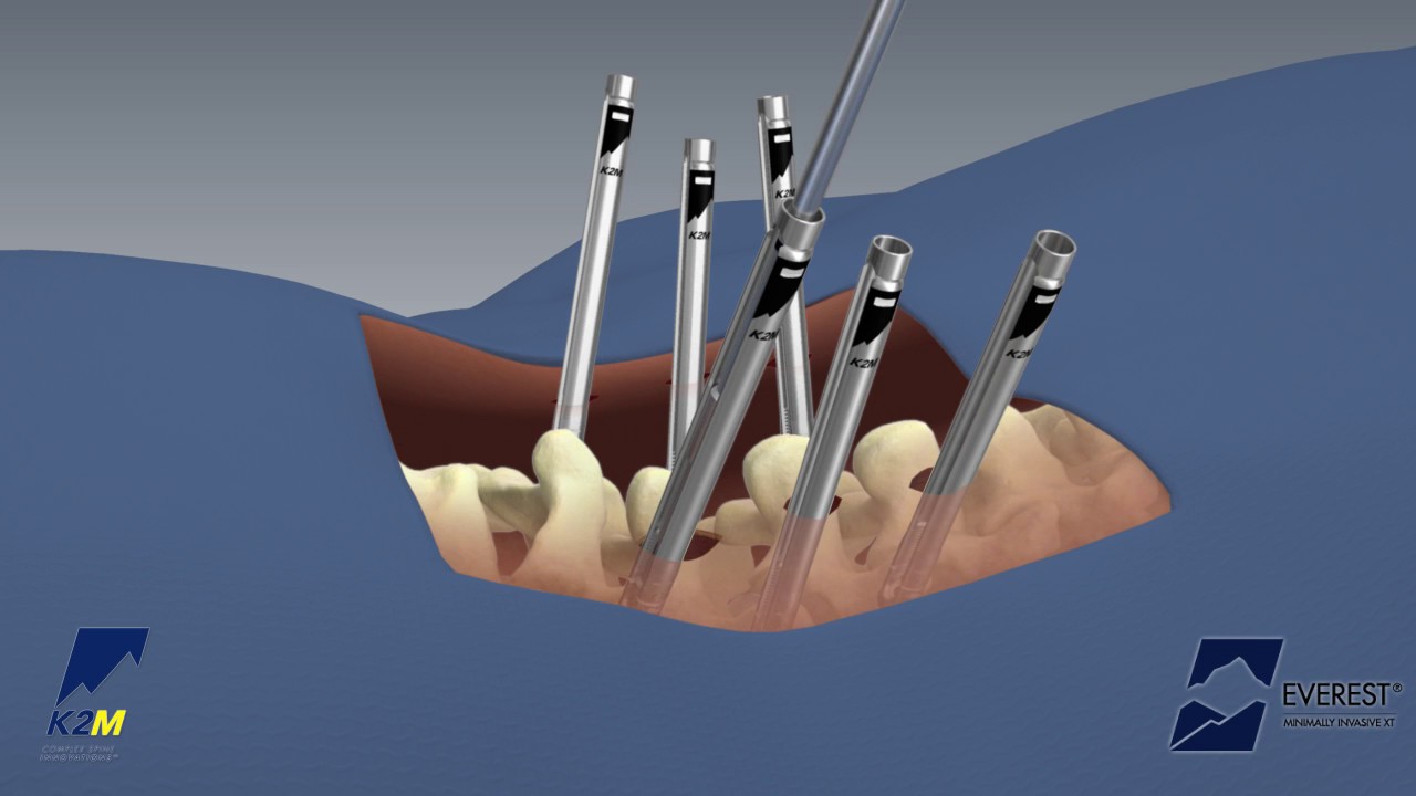 EVEREST® Minimally Invasive XT Spinal System Product Animation