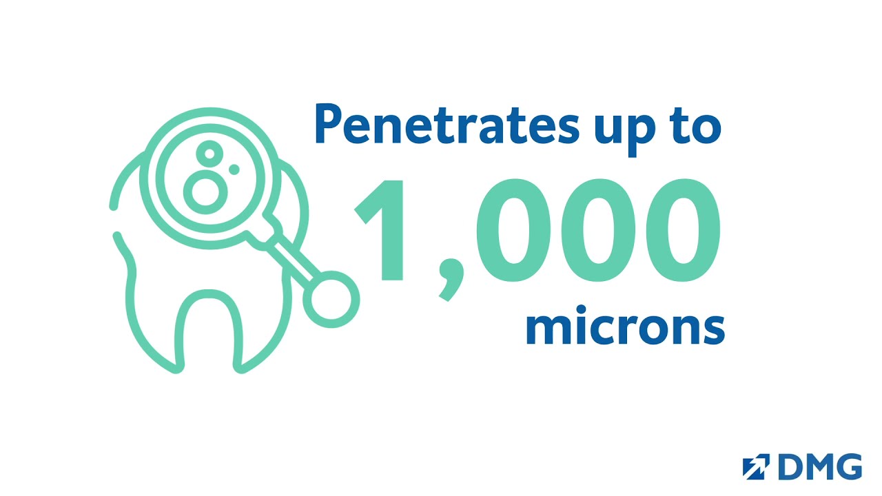 Icon Caries Infiltrant: in 60 seconds