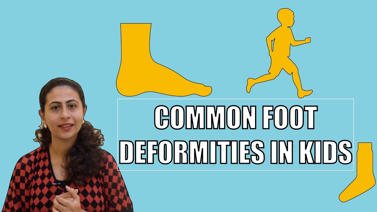 COMMON FOOT DEFORMITIES IN KIDS