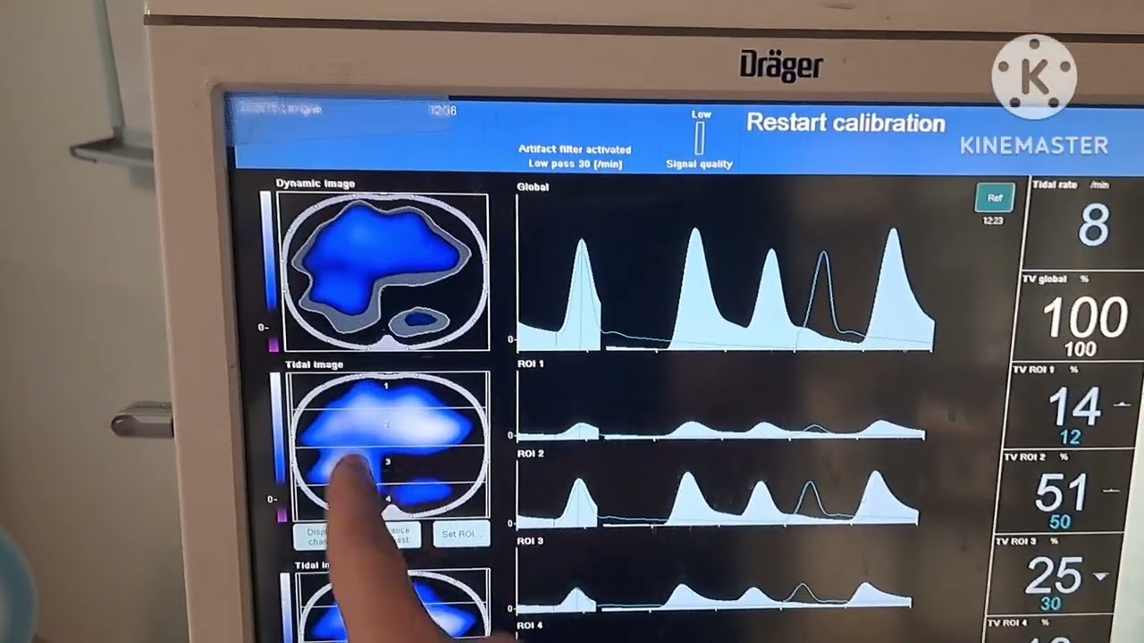 PulmoVista 500 Guided Lung Recruitment of Left Dorsal Region.