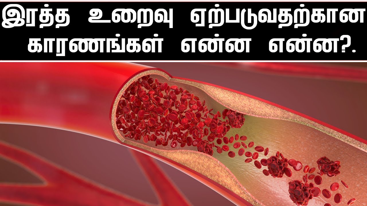 இரத்த உறைவு ஏற்படுவதற்கான காரணங்கள் என்ன என்ன?.