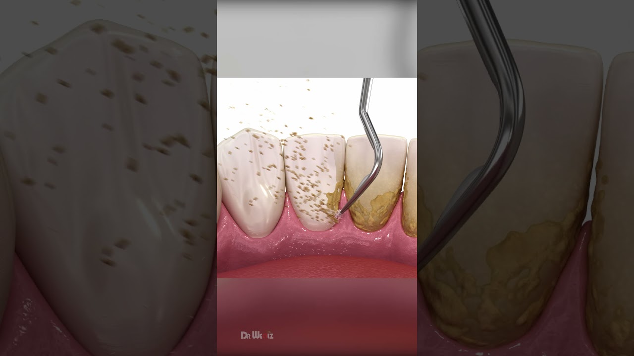Scaling and Root Planing Therapy: AMSR