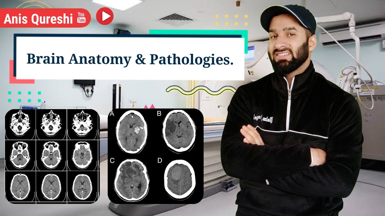NCCT Brain | Anatomy & Pathologies | By Anis Qureshi