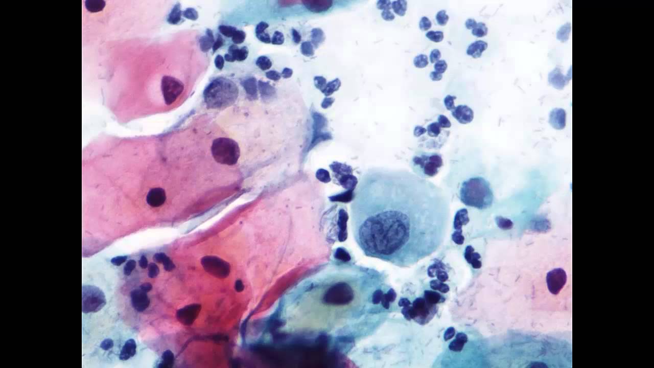 5.  Atipia de células escamosas (citología de cribado de cáncer de cuello uterino)