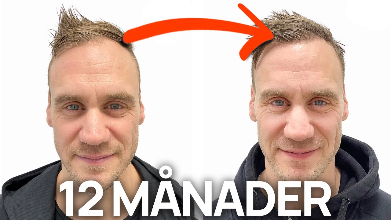 Jag har gått och funderat i 1 år | Hårtransplantation