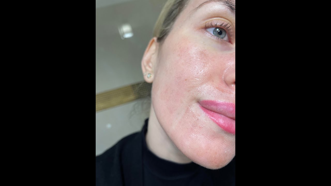 Laser frakcyjny CO2 - moja opinia, efekty dzień po dniu, czy warto?